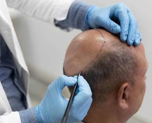 Micrograft Hair Transplant in Dubai