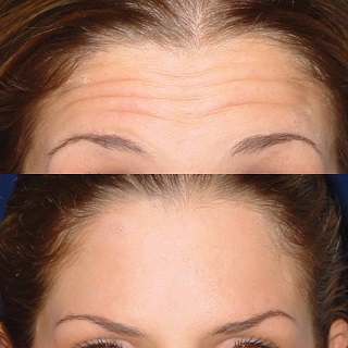 Botox injection to the forehead