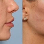 Jawline contouring by filler injection in Dubai