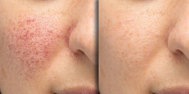 acne scar treatments
