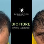 biofibre hair transplant in dubai