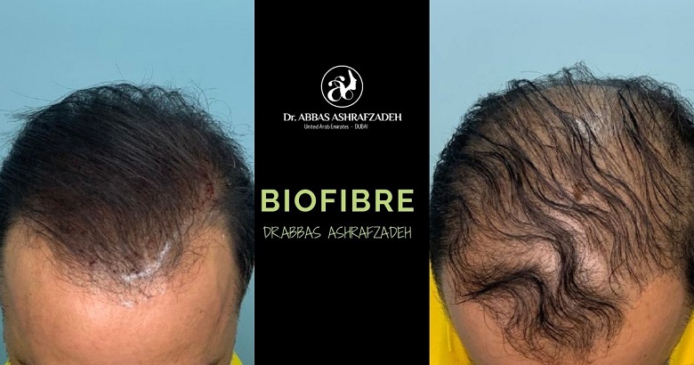 Biofibre Hair Transplant In Dubai - Dr Abbas Ashrafzadeh