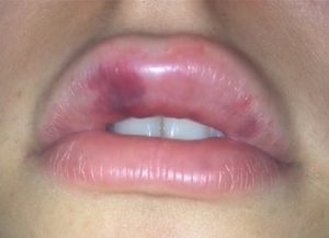 Bruising After Lip Filler Injection And How To Treat It - Dr Abbas ...