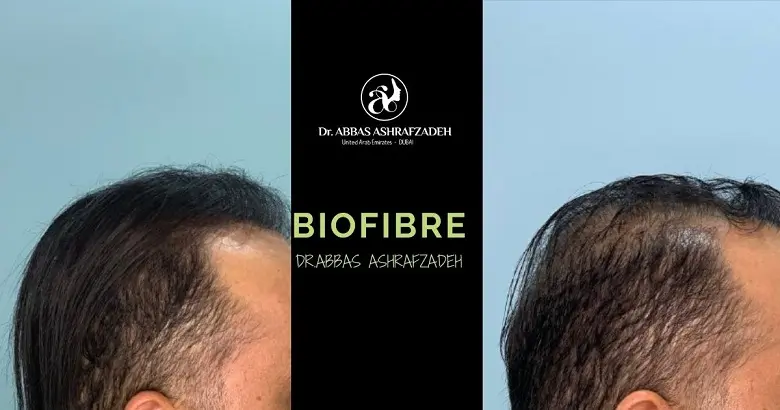 Biofibre Hair Transplant Dr Abbas Ashrafzadeh