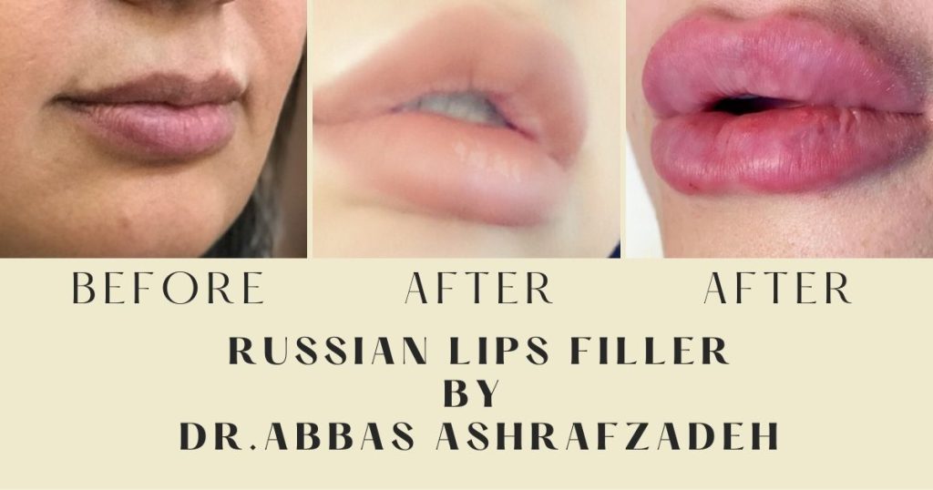 Who Can i Have Russian Lips Style With Filler