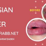 russian lip filler injection