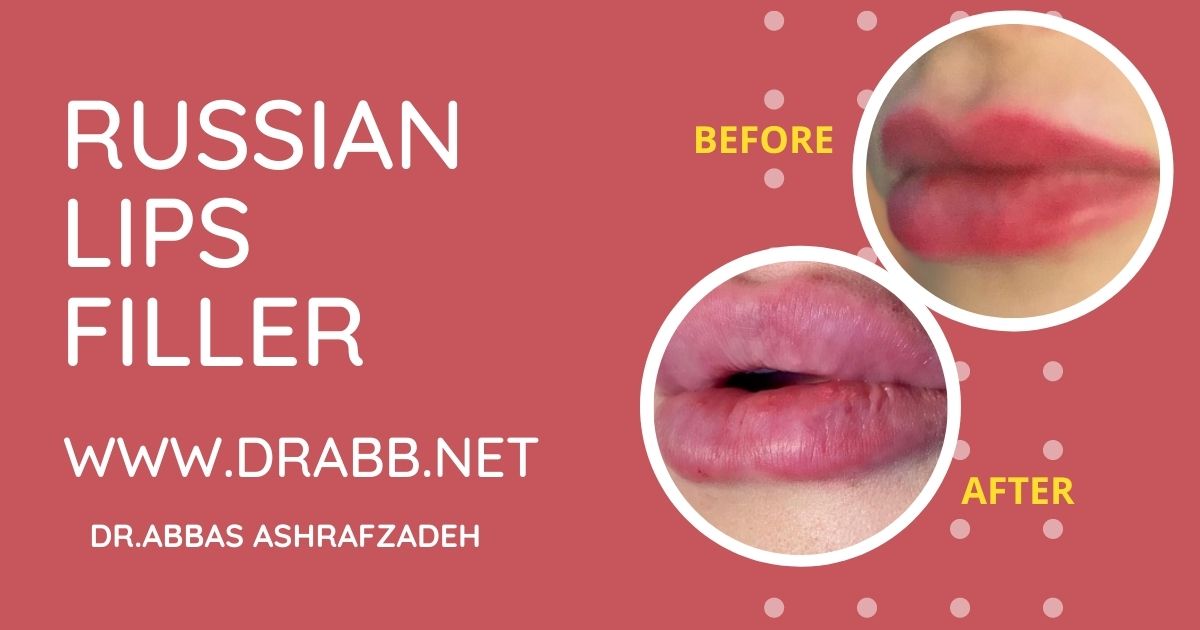 russian lip filler injection