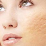 scar acne treatment