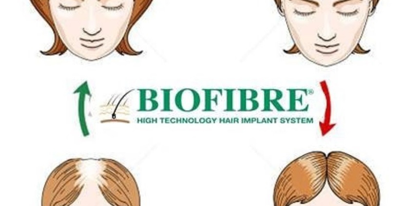 The best method of artificial hair transplantation
