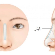 nose filler injection in dubai 2022 (rhinoplasty)