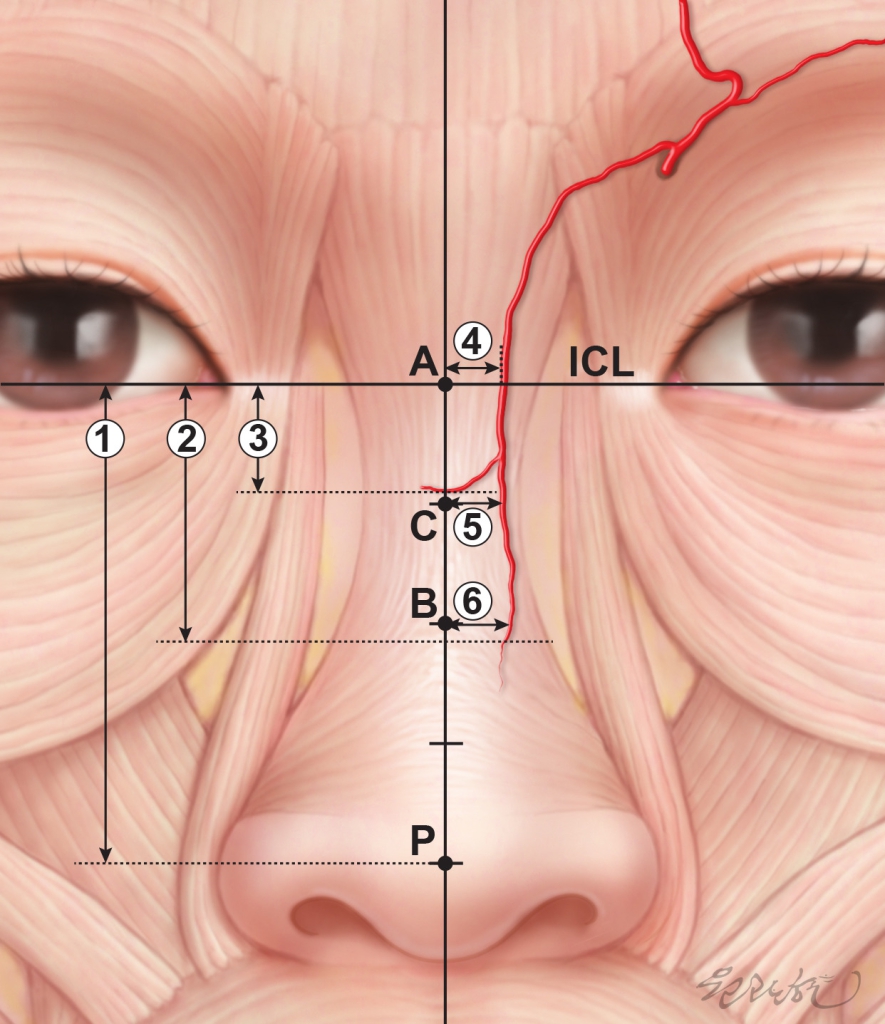 dorsal nasal filler