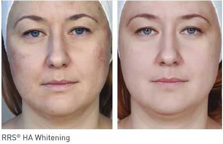 What results will I see after mesotherapy in duba