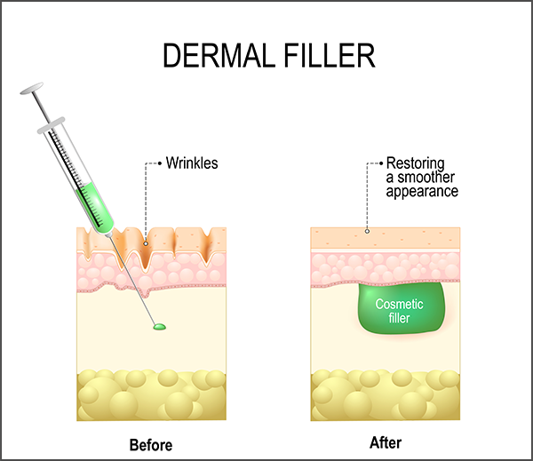 fat transfer or filler-1