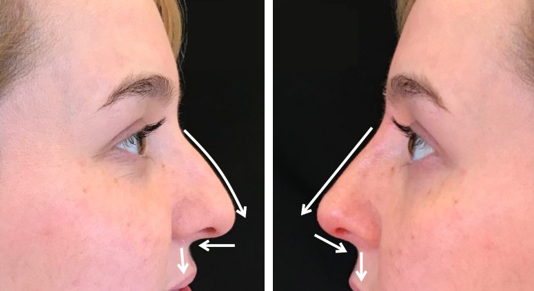 nose job without surgery