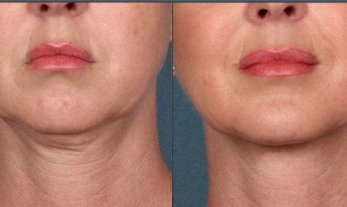 double chin mesotherapy 2022