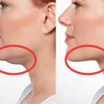 double chin mesotherapy dubai
