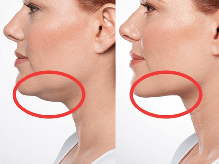 double chin mesotherapy dubai