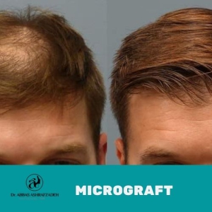 micrograft hair transplant