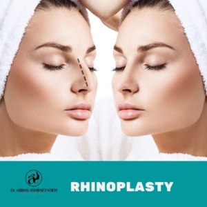 rhinoplasty