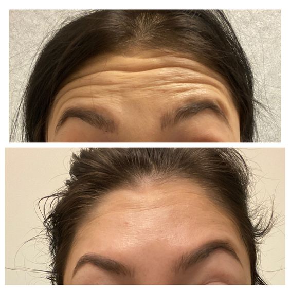 forehead botox before and after in dubai