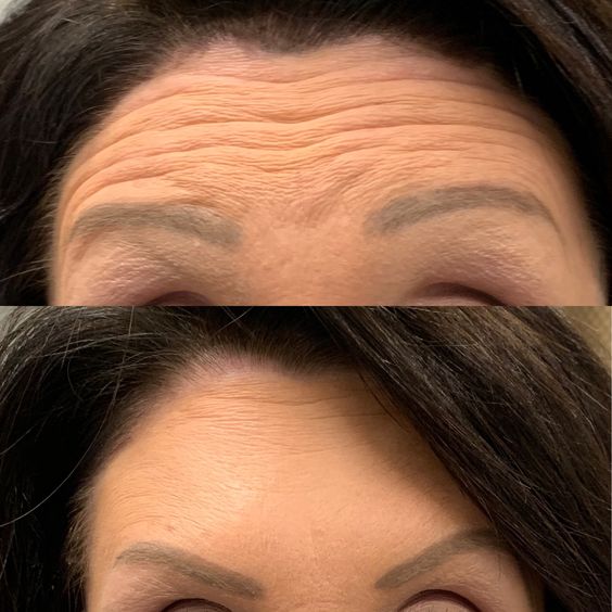 forehead botox before and after