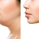 all you need to know about jawline fillers