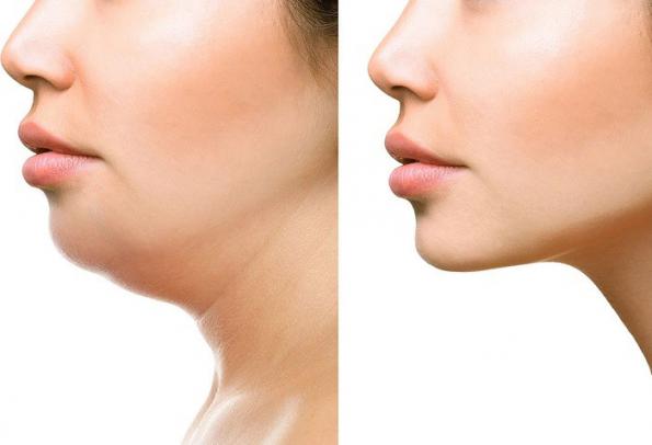all you need to know about jawline fillers