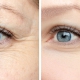 effectiveness of Botox in facial rejuvenation