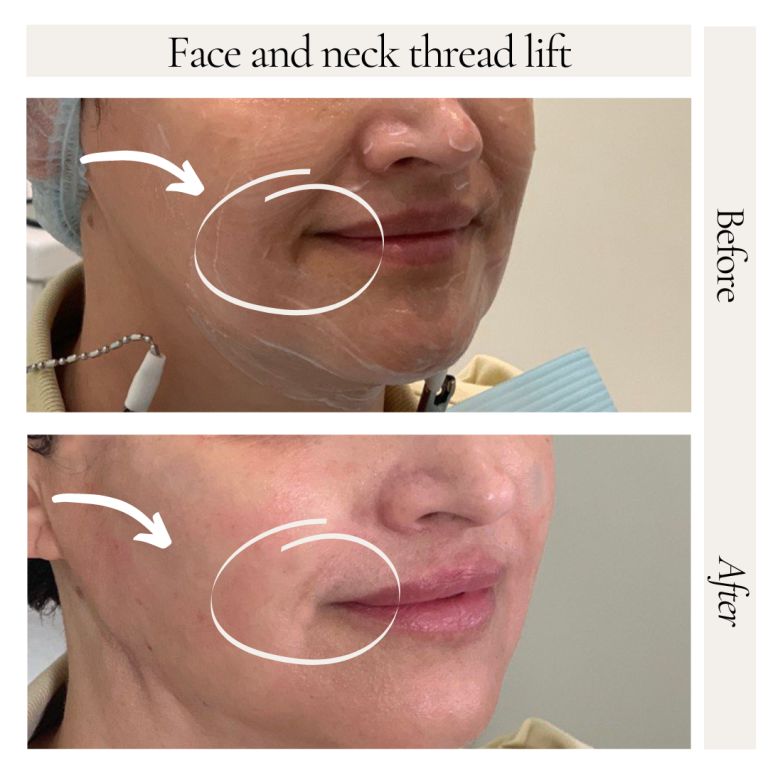 NonSurgical Facelift With Silhouette Soft In Dubai